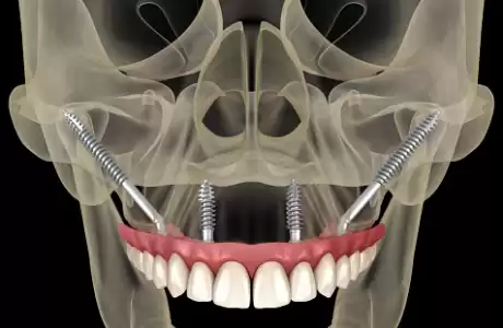 ¿Qué son los implantes cigomáticos? -   